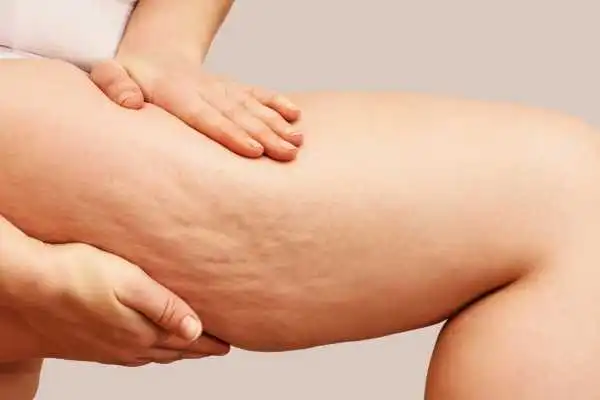 Image of woman showing leg with cellulite Lowestoft