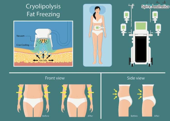 Image of diet and fat freezing combined for best results for Spire Aesthetics Lowestoft
