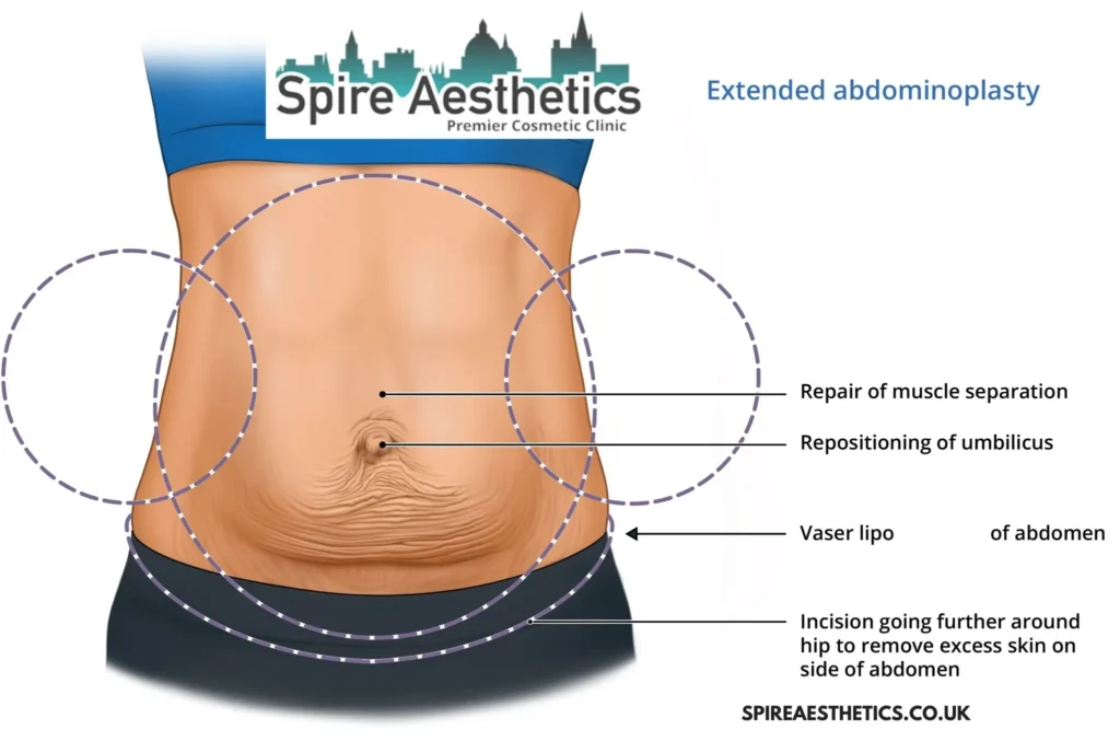 Understanding Loose Skin After Gastric Band Lowestoft Surgery and HIFU Treatment