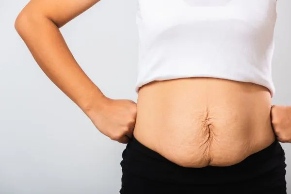 Image of a woman's stomach after weight loss with sagging skin following a gastric band Lowestoft