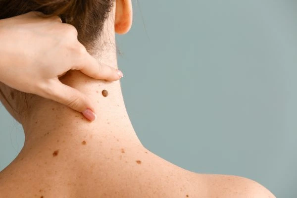 skin blemish removal Lowestoft treatment