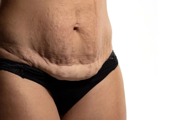 Image of womans stomach after weight loss injections Lowestoft showing saggy skin